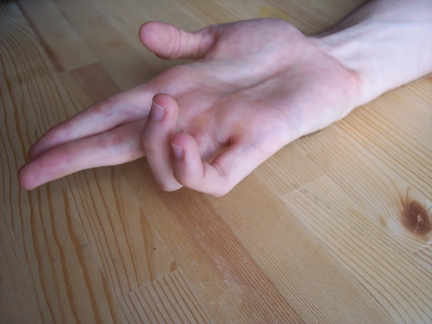 Healthy hand imitating an ulnar claw of the 4th and 5th fingers