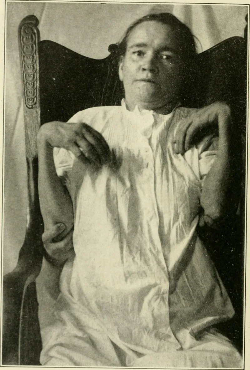 Seated patient with bilateral wrist drop